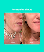 Blemish Patches Pack